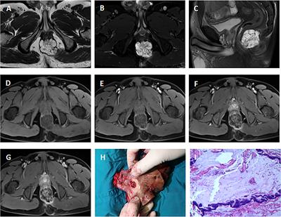 Adjuvant chemoradiotherapy does not improve outcomes in patients with fistula-associated anal adenocarcinoma undergoing abdominoperineal resection